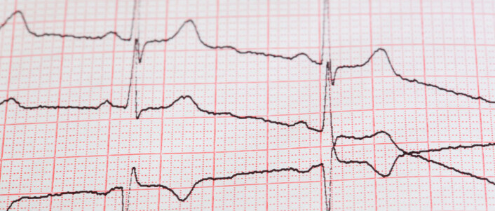 Epileptiske anfall deles normalt i to hovedgrupper: Den største gruppen er fokale anfall (partial seizure), hvor anfallet har sitt opphav i et avgrenset sted i hjernen. Den andre gruppen er generaliserte anfall (generalized seizure), hvor anfallene kommer dypt inne fra hjernen og raskt sprer seg til hele hjernen. (Foto: Colourbox.com) Epileptiske anfall deles normalt i to hovedgrupper: Den største gruppen er fokale anfall (partial seizure), hvor anfallet har sitt opphav i et avgrenset sted i hjernen. Den andre gruppen er generaliserte anfall (generalized seizure), hvor anfallene kommer dypt inne fra hjernen og raskt sprer seg til hele hjernen. (Foto: Colourbox.com)