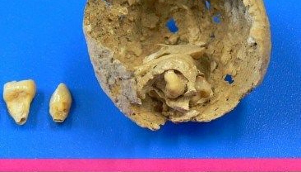 Skrekksvulst med tenner funnet i 1600 år gammelt lik