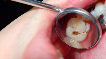 Får noen av oss lettere hull i tennene enn andre?