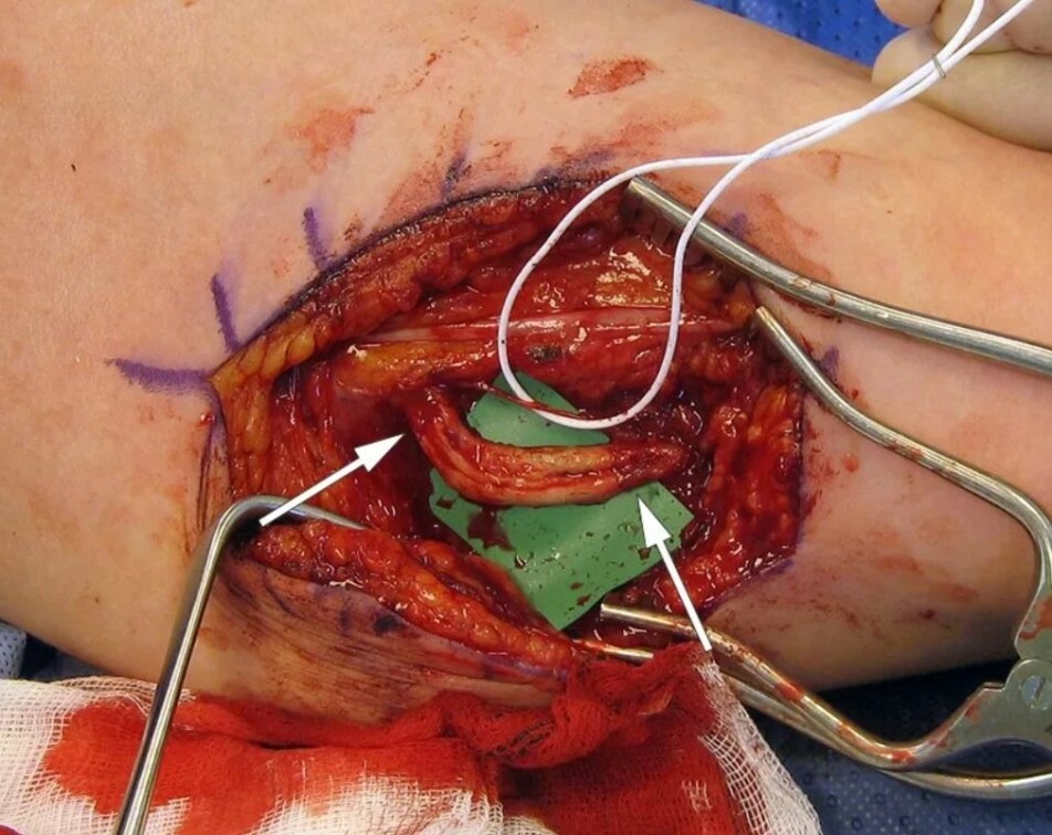 Dette er et operasjonsbilde tatt av den første pasienten. Du kan se en liten del av ulnarisnerven kirurgene klarte å redde som holdes vedd med hvit strikk. Det du ser under er delen av ulnarisnerven som måtte erstattes med et nervegraft. Skjøtene for nervegraften er ved de hvite pilene.