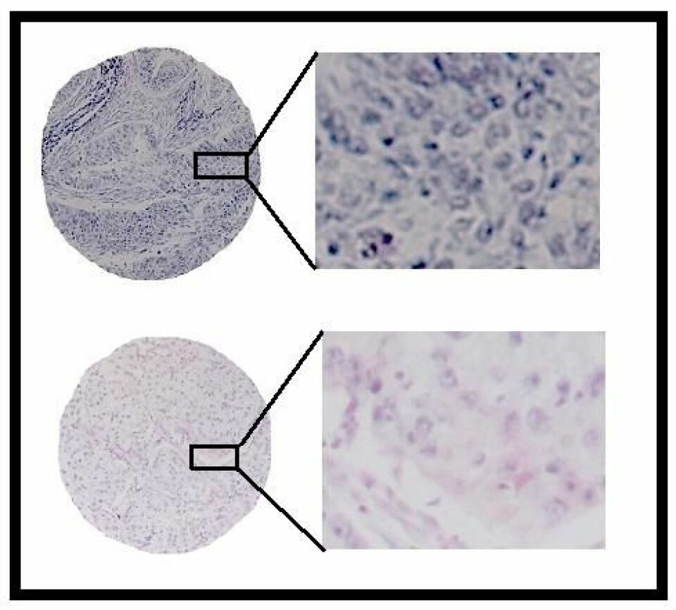 Figuren viser farging for biomarkøren miR-126 (blå farge) i lungekreftvev. Denne biomarkøren er knyttet til angiogenese, og de med mye miR-126 (øverst) har en dårligere prognose enn de med lite miR-126 (nederst). (Figur: Tom Dønnem, UiT)