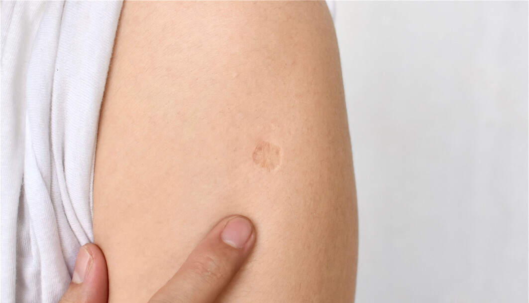 BCG-vaksinen beskytter mot mer enn tuberkulose. BCG-vaksinen beskytter mot mer enn tuberkulose.