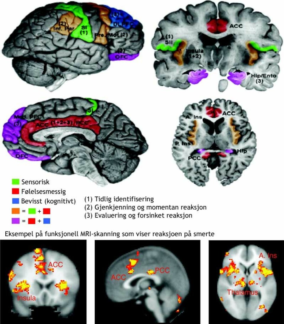 Figurene viser hvordan forskerne tror smerte behandles i hjernen. (Figur: Borsook D, Moulton EA, Schmidt KF, Becerra LR., Creative Commons, se lisens. Figuren er oversatt og bearbeidet av forskning.no)