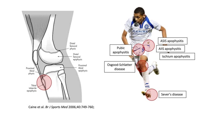 Different growth plates are particularly prone to injury during maturation. The tendon attachment for the quadriceps (thigh muscle) at the upper end of the tibia (lower leg) is one such place (see fact box). Different growth plates are particularly prone to injury during maturation. The tendon attachment for the quadriceps (thigh muscle) at the upper end of the tibia (lower leg) is one such place (see fact box).