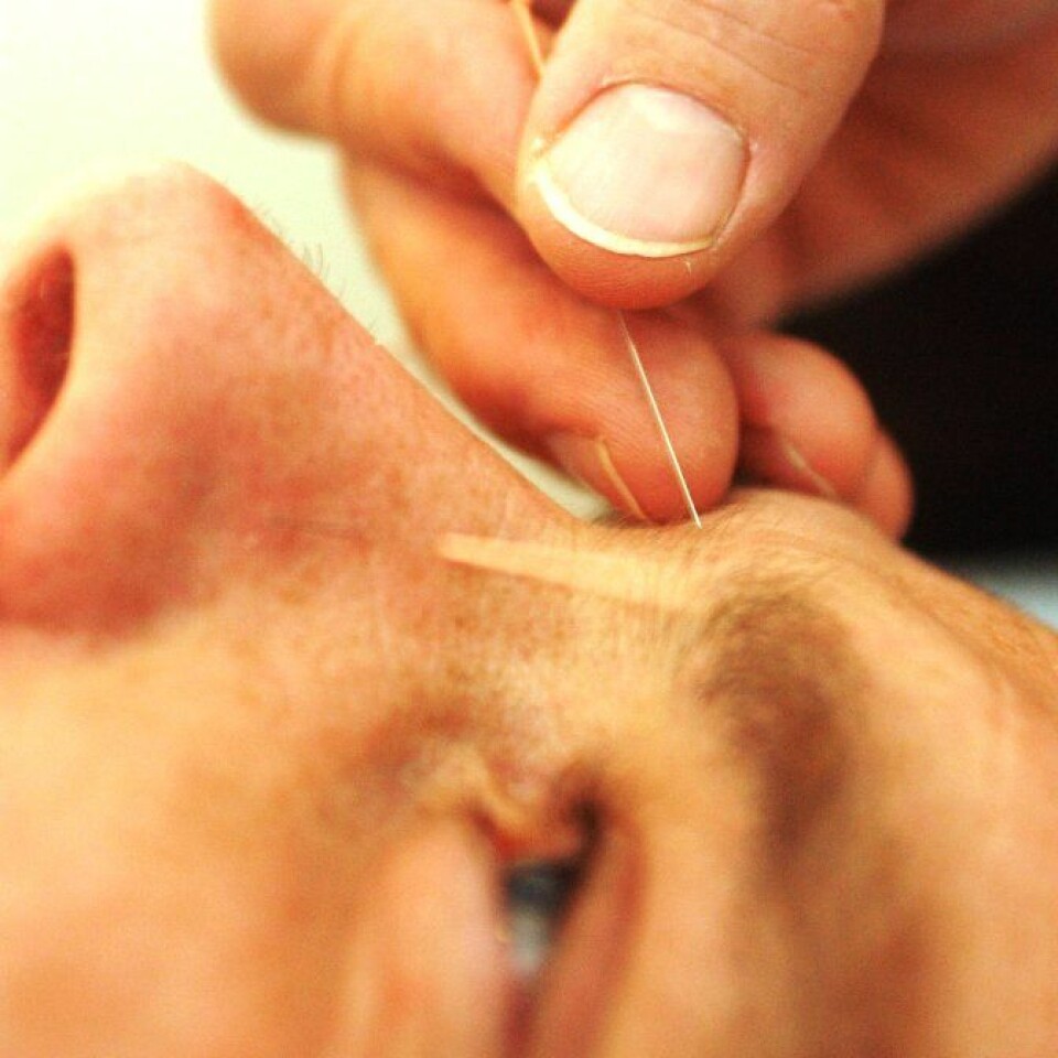 Akupunktur kan frigjøre kroppens egne smertestillende stoffer, ifølge en ny studie. (Foto: www.colorbox.no)