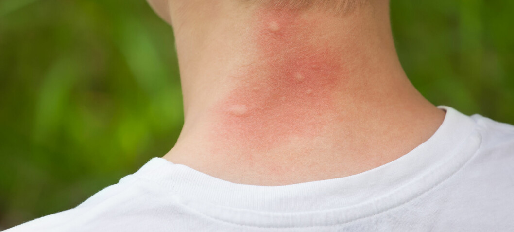 Kan du bli immun mot myggstikk?