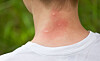 Allergisk Mot Mygg () Allergisk Mot Mygg