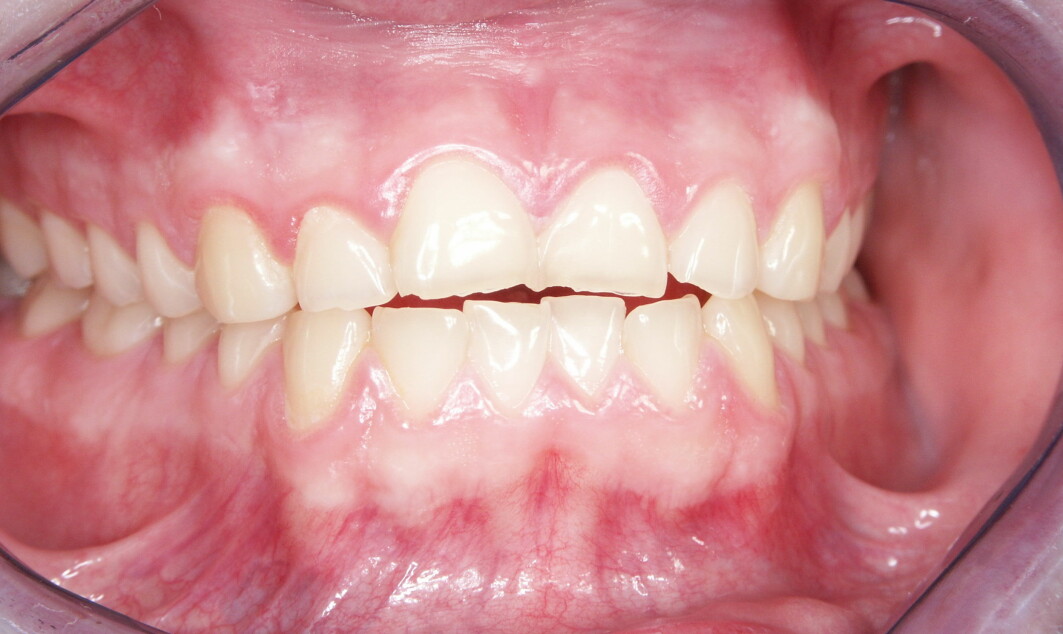 Syreskader kjennetegnes av at tennene slites ned. De blir kortere og flisete.