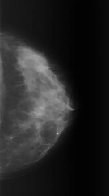 På mammogrammet er det områder som er lyse (radiotette) og områder som er mørke. (Foto: Giske Ursin)