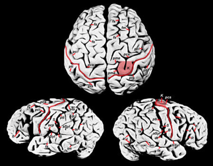 "Einsteins hjerne. Hadde den trekk som kan forklare hans genialitet? (Foto: Dean Falk/S. Witelson et al., The Lancet, 353, 19 June 1999)" "Einsteins hjerne. Hadde den trekk som kan forklare hans genialitet? (Foto: Dean Falk/S. Witelson et al., The Lancet, 353, 19 June 1999)"