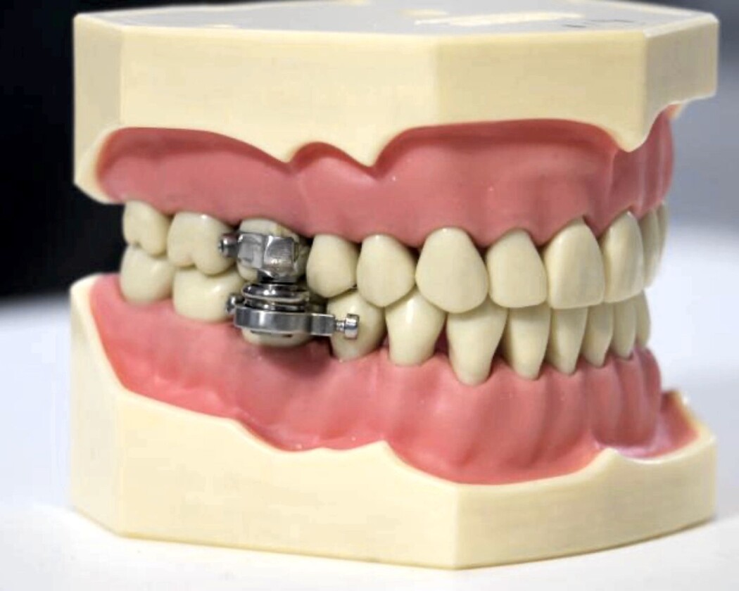 Forskere fra New Zealand og Storbritannia står bak DentalSlim Diet Control – en magnet som låser igjen munnen. Forskere fra New Zealand og Storbritannia står bak DentalSlim Diet Control – en magnet som låser igjen munnen.