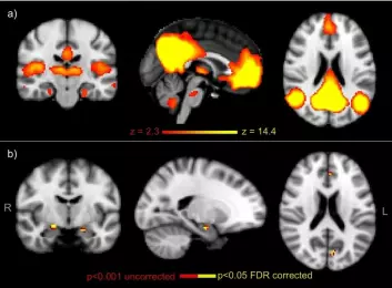 "A: Representerer hjerneaktiviteten for alle 36 forsøkspersoner mens de utforte minnekrevende oppgaver. B: Viser de områdene hvor ApoE4-bærere hadde høyere aktivitet enn ikke bærere. (Kilde: PNAS)"
