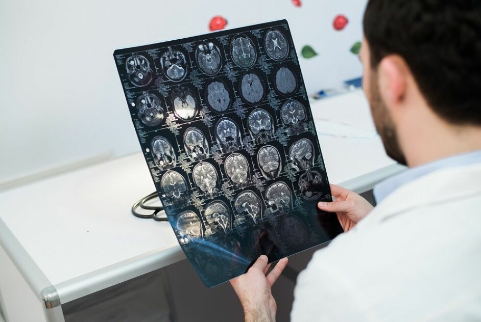 Studien viser at det ved hjelp av MR bilder av hjernen er mulig å identifisere pasienter i faresonen for kognitiv svikt som oppstår kort tid etter hjerneslaget.