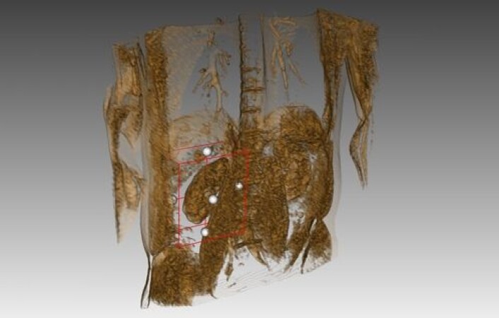 MedViz-prosjektet MRI-Kidney har som mål å diagnostisere nyresykdom på et tidlig tidspunkt basert på MR-opptak. Prosjektet er et eksempel på at teknologene gjør sitt inntog i sykehusene da det her er både leger, MR-fysikere, matematikere og informatikere med på teamet. (Foto: MedViz) MedViz-prosjektet MRI-Kidney har som mål å diagnostisere nyresykdom på et tidlig tidspunkt basert på MR-opptak. Prosjektet er et eksempel på at teknologene gjør sitt inntog i sykehusene da det her er både leger, MR-fysikere, matematikere og informatikere med på teamet. (Foto: MedViz)