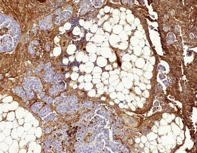 Surviving cancer cells (light blue nucleus) surrounded by fibrotic tissue.