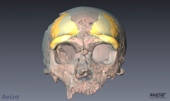 Modell av en neandertalskalle. Fragmentet funnet i Nordsjøen er scannet og lagt inn i gult. Det er også lagt inn et speilbilde av fragmentet, også i gult. (Foto: Max Planck Institute for Evolutionary Anthropology, Leipzig, Tyskland) Modell av en neandertalskalle. Fragmentet funnet i Nordsjøen er scannet og lagt inn i gult. Det er også lagt inn et speilbilde av fragmentet, også i gult. (Foto: Max Planck Institute for Evolutionary Anthropology, Leipzig, Tyskland)