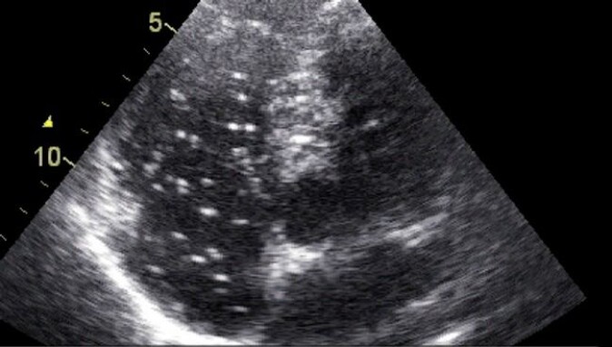 Decompression sickness occurs when you come up too fast from a dive. Gas bubbles form in the blood and tissues due to the reduced pressure. The white dots in the image are gas bubbles in the heart. Decompression sickness occurs when you come up too fast from a dive. Gas bubbles form in the blood and tissues due to the reduced pressure. The white dots in the image are gas bubbles in the heart.