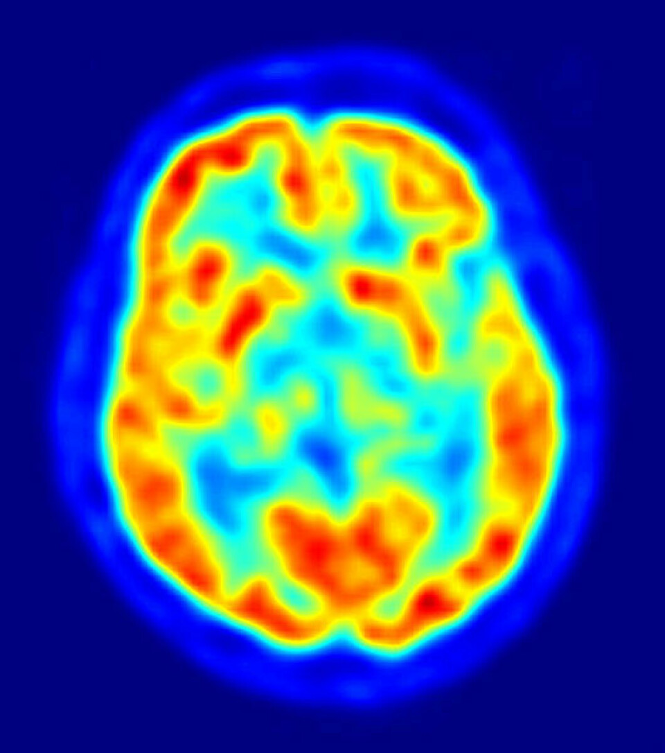 Positron-emisjons-tomografi av hjernen (Bilde: Jens Langer, Wikimedia Commons)