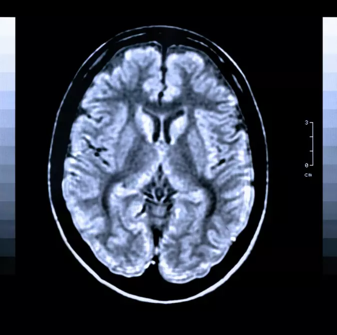 – Ved hjelp av MR-bilder av hjernen kan vi med en god sikkerhet identifisere risikopasienter for utvikling av kognitiv svikt etter slag, forteller Till Schellhorn.