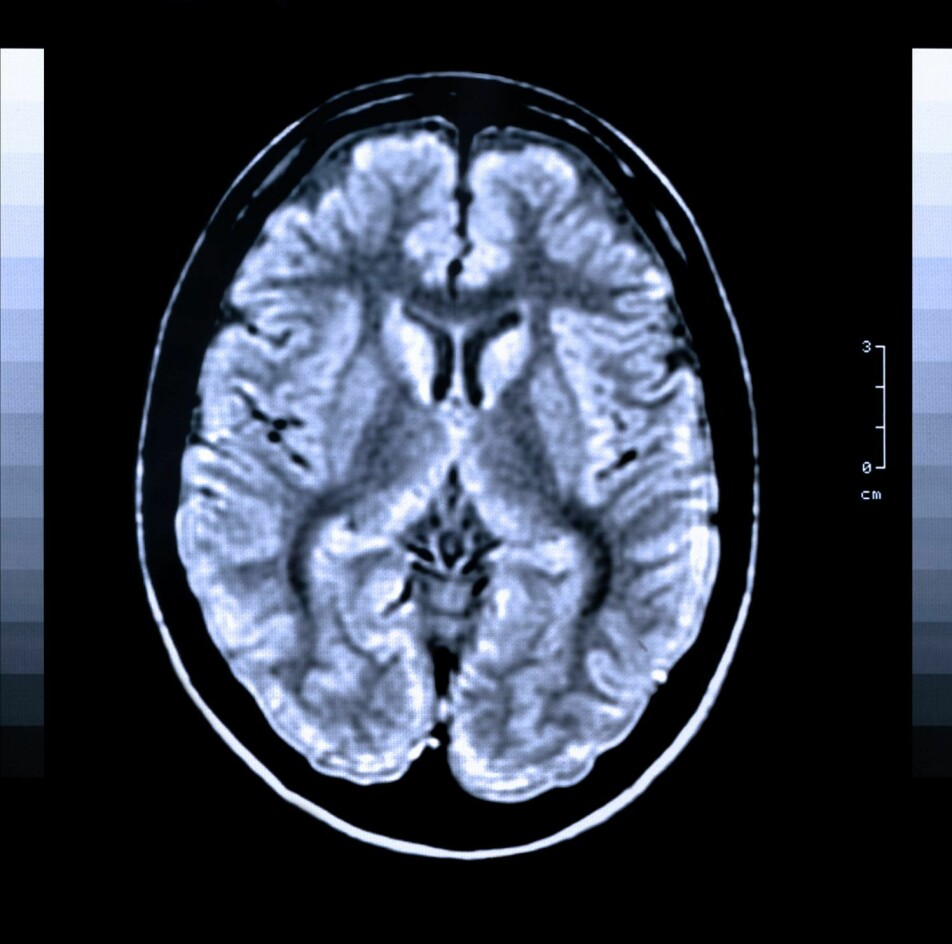 “Using MRI images of the brain, we can identify risk patients for the development of cognitive impairment after stroke with good certainty,” says Till Schellhorn.
