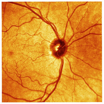 Retina, også kalt netthinnen. Dette er øyets lysfølsomme del. Her ses netthinnen til en person med normalt syn. (Foto: Science/AAAS) Retina, også kalt netthinnen. Dette er øyets lysfølsomme del. Her ses netthinnen til en person med normalt syn. (Foto: Science/AAAS)