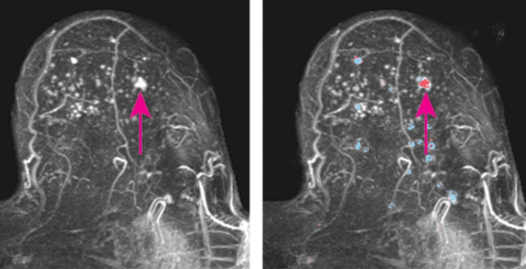 MR-bilde av et bryst med tett brystvev. Den rosa pilen viser en kreftsvulst. Bildet til høyre viser områder i brystet som den kunstige intelligensen har vurdert. Rød betyr høy sannsynlighet for kreft. MR-bilde av et bryst med tett brystvev. Den rosa pilen viser en kreftsvulst. Bildet til høyre viser områder i brystet som den kunstige intelligensen har vurdert. Rød betyr høy sannsynlighet for kreft.