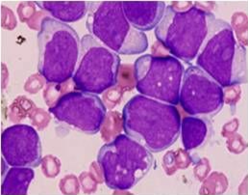 Opphoping av leukemiceller blant røde blodceller i et benmargsutstryk fra en leukemipasient.