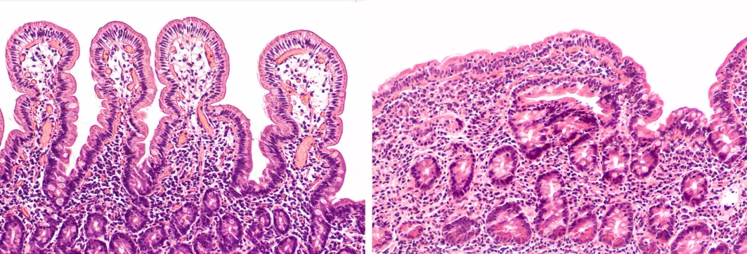 Bildet viser et tverrsnitt av veggen i tynntarmen. Til venstre ser du normale tarmtotter, mens bildet til høyre viser hvordan betennelse som følge av cøliaki ødelegger tarmveggen.