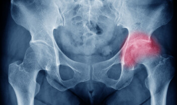 Færre kvinner får hoftebrudd, men kan vi forebygge enda flere?