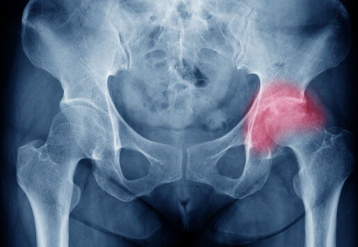 Færre kvinner får hoftebrudd, men kan vi forebygge enda flere?