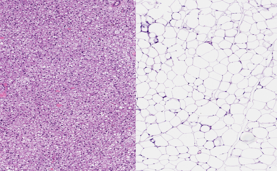 Brunt fett (til venstre) og hvitt fett (til høyre). De to typene fettceller er veldig ulike, og kanskje kan vinterbading påvirke de brune fettcellene til å øke forbrenningen.