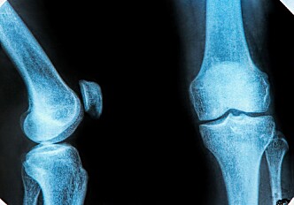 Researchers identify genes at play in people with osteoarthritis