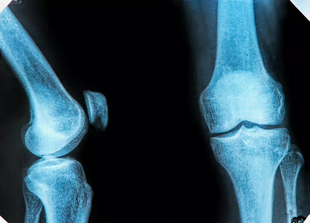 Researchers also identified the special risk factors that exist for women and for weight-bearing joints like knees.