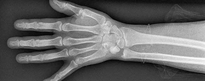 X ray of rheumatoid arthritis hand. Rheumatoid arthritis (RA) is a long-term autoimmune disorder that primarily affects joints.