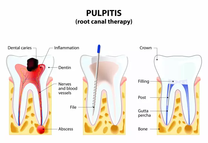 Tannen til venstre er infisert. På tannen i midten blir tannmargen fjernet. Til høyre blir den fylt igjen.