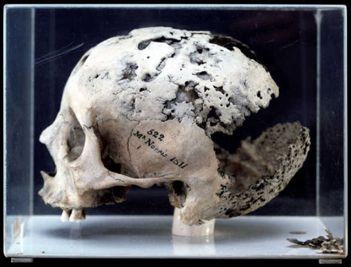 Det er ikke så hyggelig å se hva sykdommen syfilis kan gjøre med skjelettet på et menneske. (© The Hunterian Museum at The Royal College of Surgeons) Det er ikke så hyggelig å se hva sykdommen syfilis kan gjøre med skjelettet på et menneske. (© The Hunterian Museum at The Royal College of Surgeons)