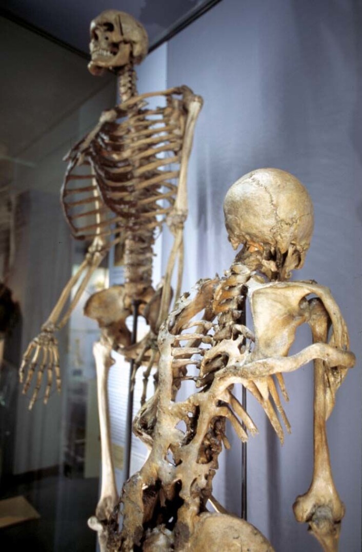 Under John Byrnes ruvende skjelett står Mr Jeffs. Han led av den sjeldne sykdommen Fibrodysplasia Ossificans Progressiva, som får muskler og vev i kroppen til å forvandle seg til bein. Til slutt blir pasienten sittende fast i et skjelett nummer to. (© The Hunterian Museum at The Royal College of Surgeons) Under John Byrnes ruvende skjelett står Mr Jeffs. Han led av den sjeldne sykdommen Fibrodysplasia Ossificans Progressiva, som får muskler og vev i kroppen til å forvandle seg til bein. Til slutt blir pasienten sittende fast i et skjelett nummer to. (© The Hunterian Museum at The Royal College of Surgeons)