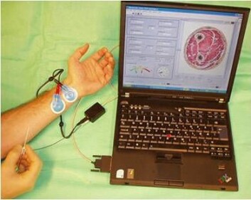 Prototype på sprøyten koblet opp mot en laptop som viser nålens plassering i vevet. (Foto: Håvard Kalvøy) Prototype på sprøyten koblet opp mot en laptop som viser nålens plassering i vevet. (Foto: Håvard Kalvøy)