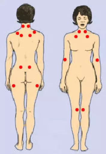 Figuren viser de 18 trykksmertepunktene som brukes for å diagnostisere fibromyalgi. ( Figur: National Institute of Arthritis and Musculoskeletal and Skin Diseases (NIAMS), fargelagt av forskning.no)