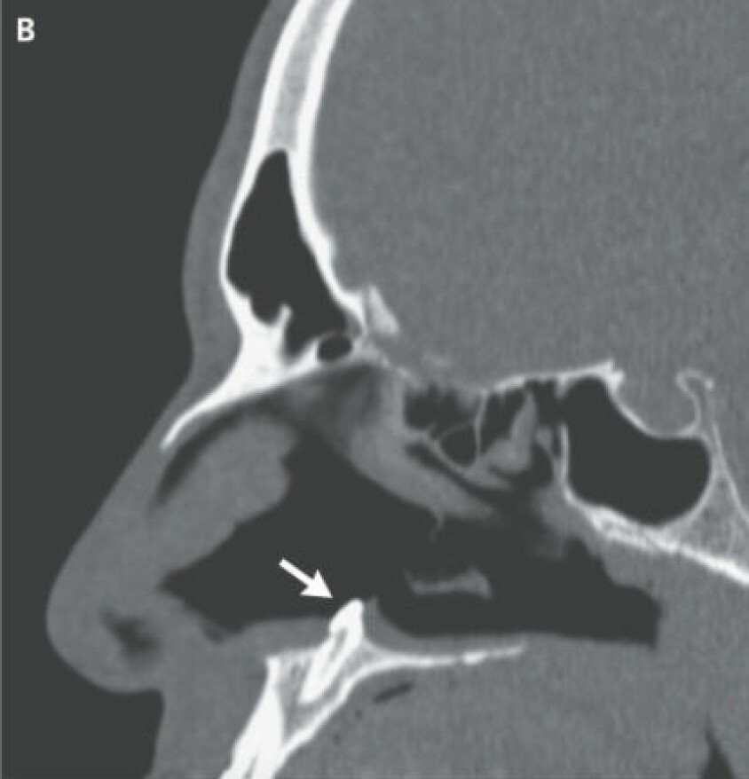 Røntgenbilde av tanna i nesa.