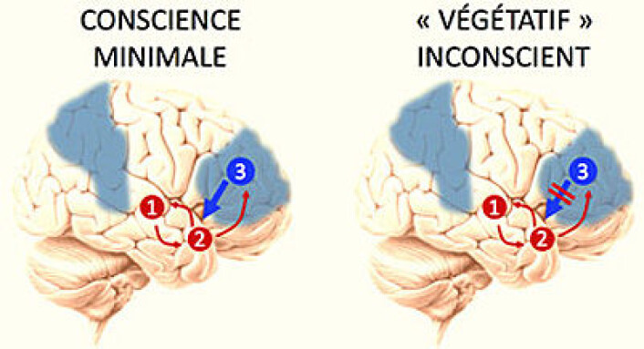 I den minimalt bevisste pasienten kan hjerneområdene 2 og 3 utveksle opplysninger. Det kan de ikke i den vegetative pasienten – her foregår kommunikasjonen bare den ene veien. (Grafikk: Université de Liège) I den minimalt bevisste pasienten kan hjerneområdene 2 og 3 utveksle opplysninger. Det kan de ikke i den vegetative pasienten – her foregår kommunikasjonen bare den ene veien. (Grafikk: Université de Liège)