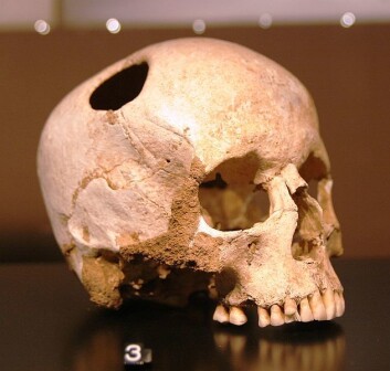 I det gamle Egypt laget man et hull i kraniet (en trepanering) når folk gjentatte ganger ble rammet av migreneanfall. Og det er vitnesbyrd om at noen overlevde inngrepet. Historien forteller at man gjorde det for å slippe ut de onde åndene. I det gamle Egypt laget man et hull i kraniet (en trepanering) når folk gjentatte ganger ble rammet av migreneanfall. Og det er vitnesbyrd om at noen overlevde inngrepet. Historien forteller at man gjorde det for å slippe ut de onde åndene.