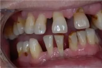 Periodontitt angriper beinet som tennene er festet i og kan føre til at en eller flere tenner løsner.