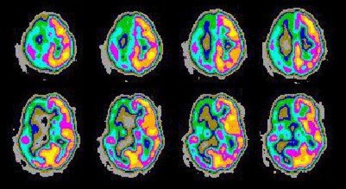 Bildet viser PET scanning av mønstre i hjernen relatert til epilepsi. (Foto: NASA) Bildet viser PET scanning av mønstre i hjernen relatert til epilepsi. (Foto: NASA)