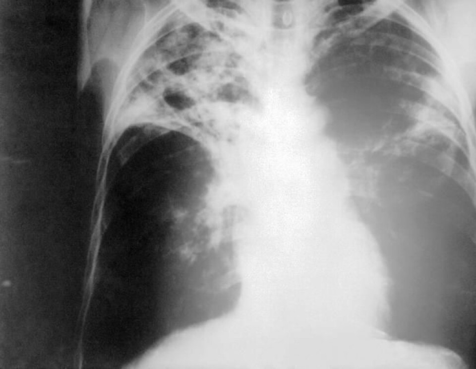 Røntgen av lunger diagnostisert med tosidig langt framskreden tuberkulosesykdom. (Foto: CDC)