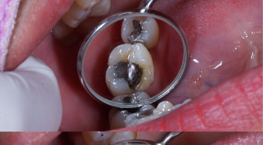 Fra amalgam til syreskader: Slik har tannproblemene våre endret seg de siste hundre årene