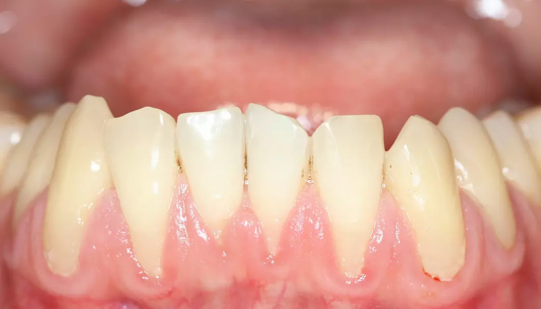 Tilbaketrukket tannkjøtt kan føre til problemer. Fjerning av tannstein er et forebyggende tiltak.