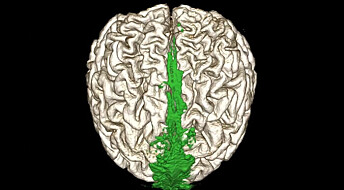 Dette er hjernens avløpssystem