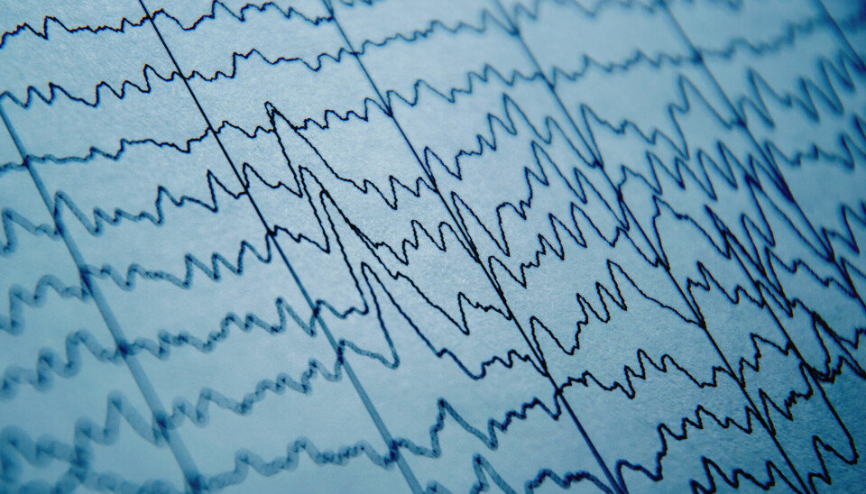 En 87-åring var koblet til en EEG-maskin da hjertet stoppet.