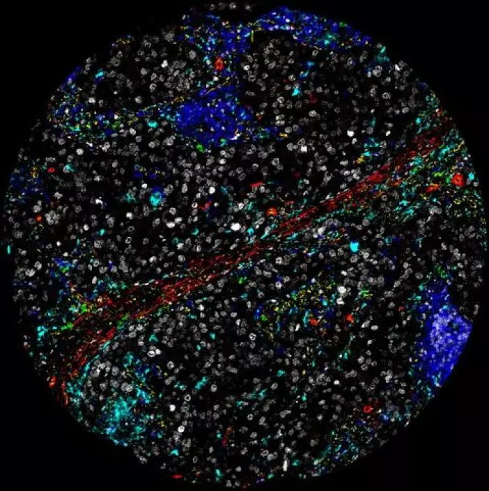 Når forskerne ser at de grå prikkene er overalt i svulsten, viser det at invasjonen av kreftceller er aggressiv. De cellene som skal stå imot invasjonen (i blått og turkis) er i mindretall.